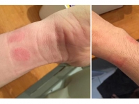想買Apple Watch？小心皮膚過敏發紅！